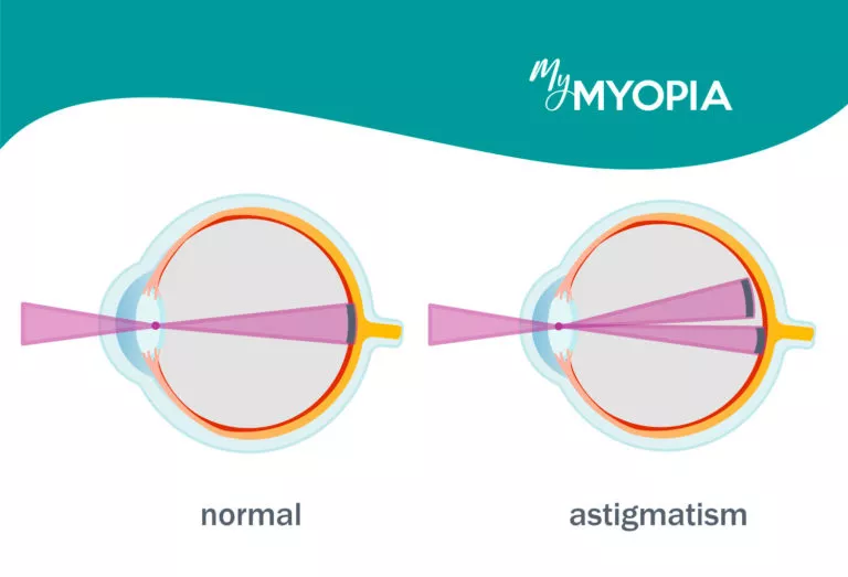 Nearsightedness, Farsightedness, And Astigmatism. What's The Difference?