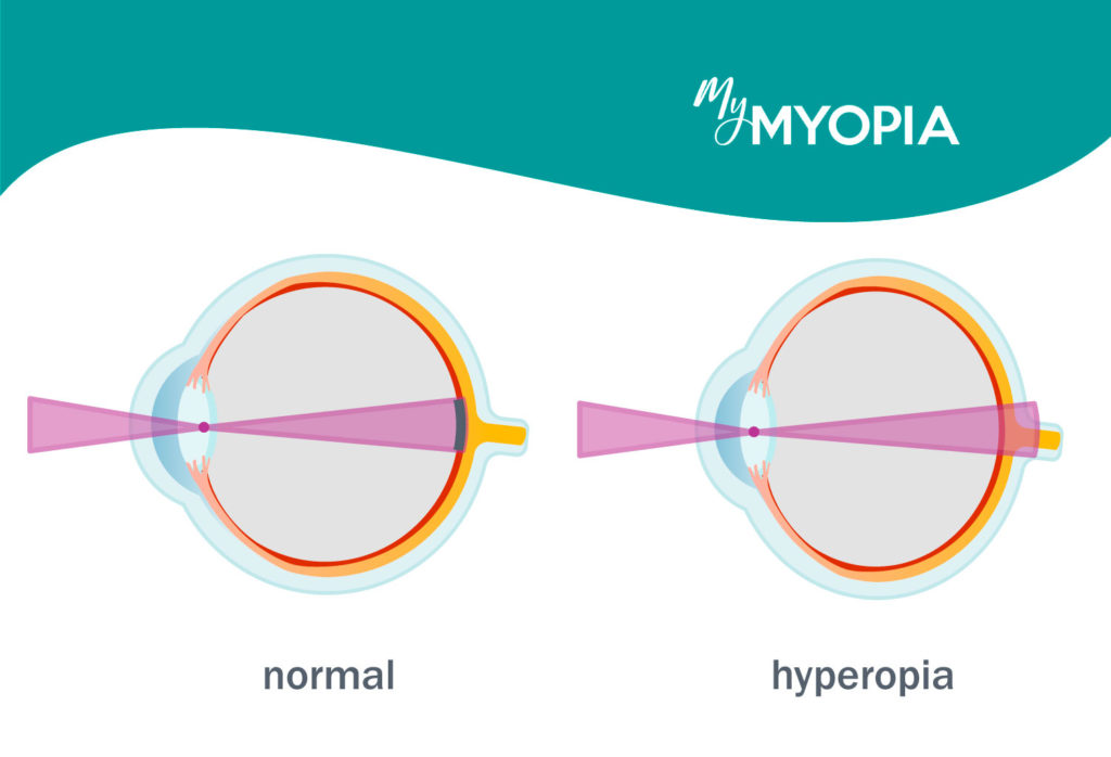 Nearsightedness Farsightedness And Astigmatism What S The Difference