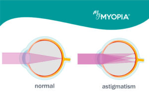 Nearsightedness, farsightedness, and astigmatism. What's the difference?