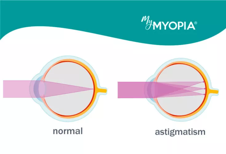 Is Nearsightedness Due to the Eyeball Being Too Long?