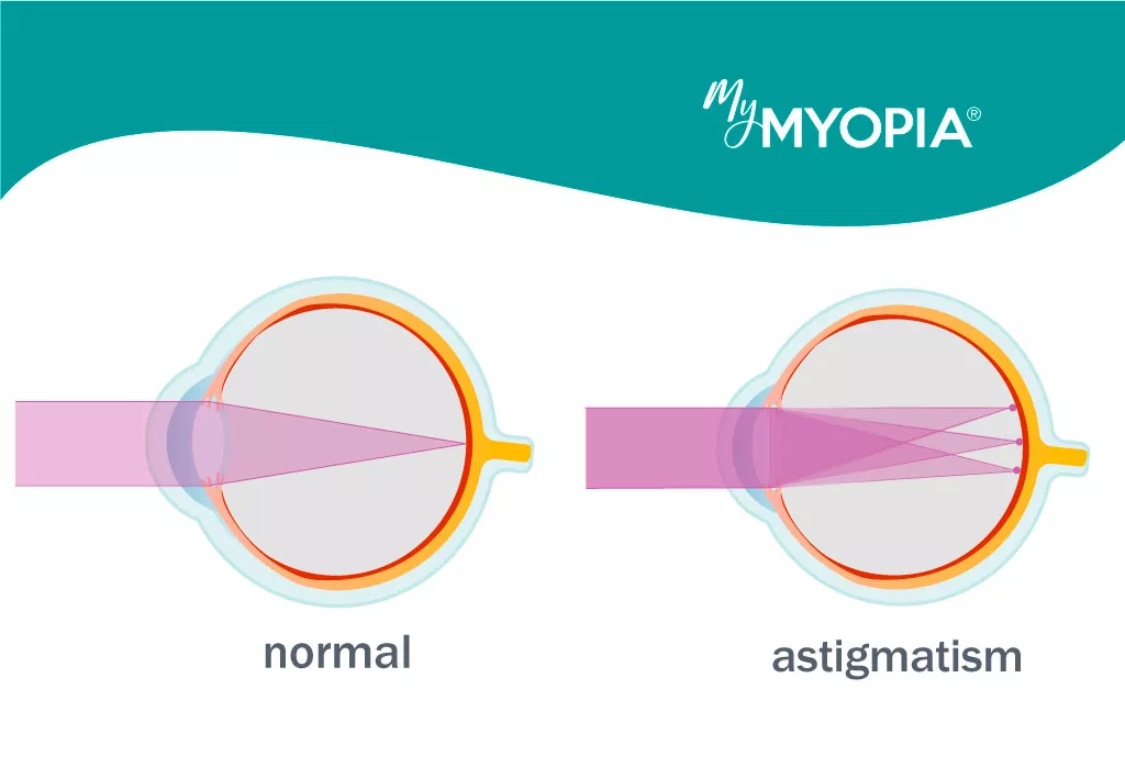 hyperopia-farsighted-vision-causes-symptoms-diagnosis-treatment