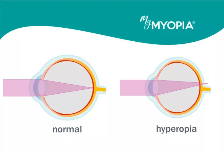 szembetegségek - myopia és hyperopia)