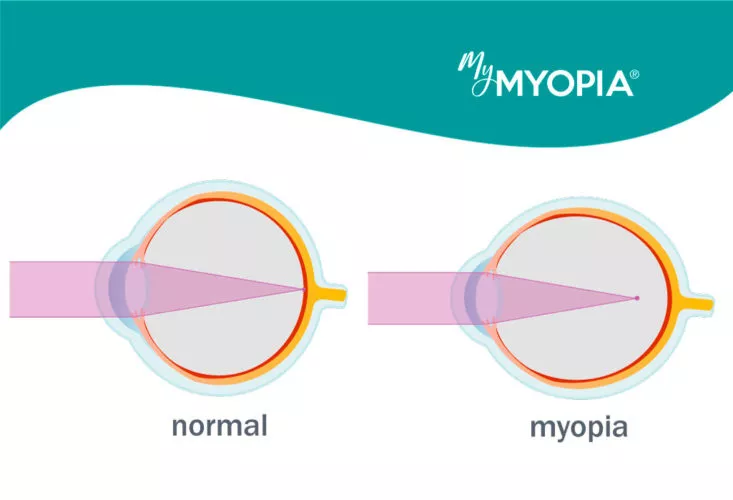 myopia and normal vision
