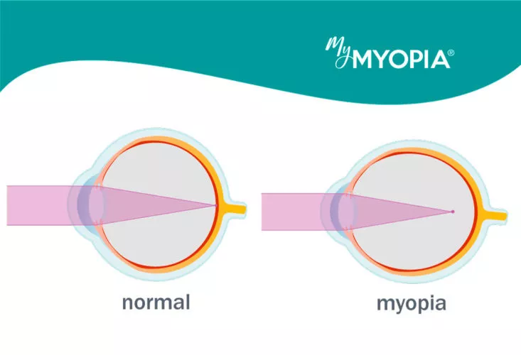 Nearsightedness Farsightedness And Astigmatism Whats The Difference