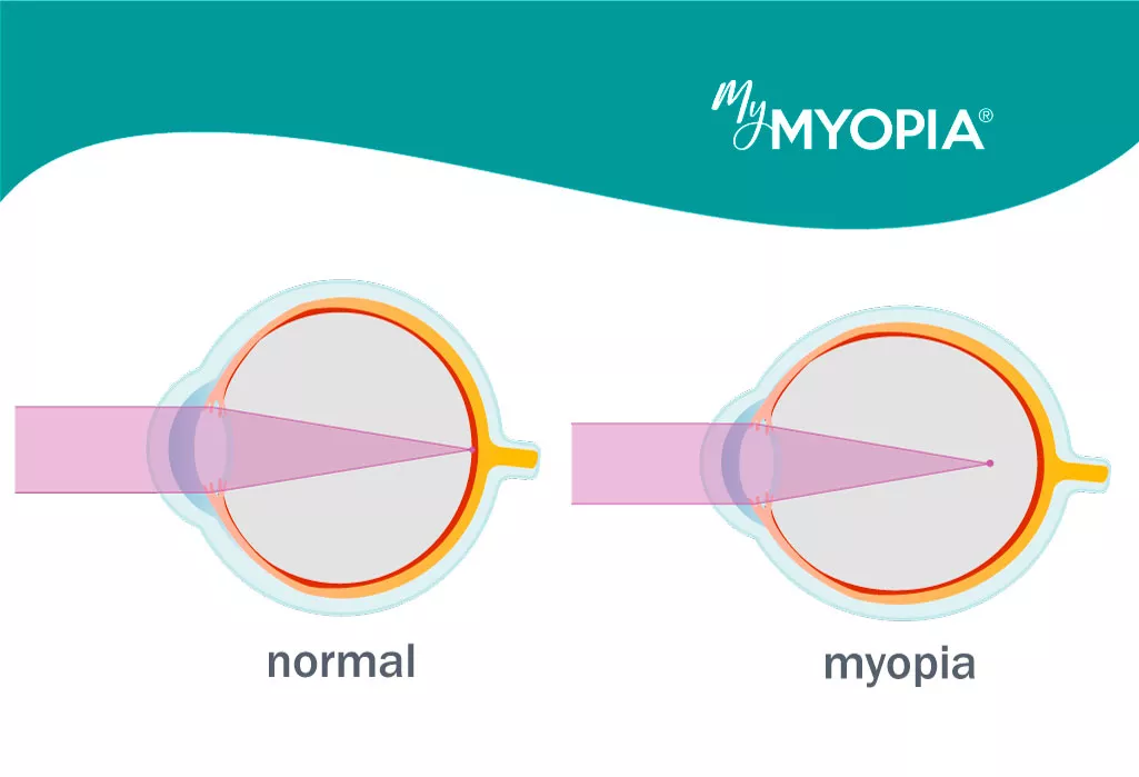myopia hypermetropia astigmatism